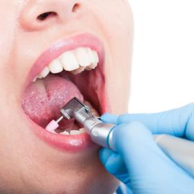 Tooth polishing