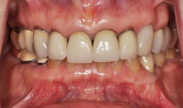 Before: Worn, unesthetic crowns and worn lower teeth