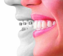 Invisalign